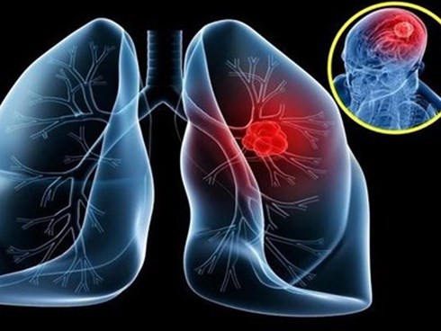 Tưởng cảm lạnh hóa ra ung thư phổi