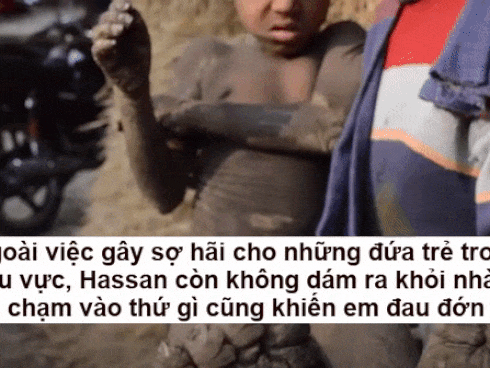 Cậu bé mắc bệnh lạ khiến cơ thể dần bị 