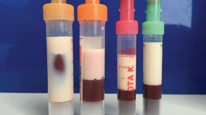 Bệnh nhân này có máu trắng như sữa và lý do thì rất nhiều người trong số chúng ta thấy lo sợ-1