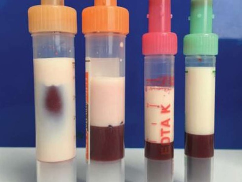 Hàng triệu người Việt mắc bệnh máu trắng như sữa vì những món ăn này-6