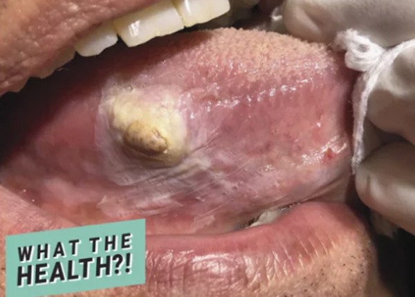 Dấu vết lạ trên lưỡi người đàn ông này hóa ra là một dạng ung thư hiếm gặp-1
