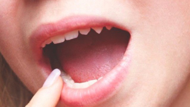 Dấu vết lạ trên lưỡi người đàn ông này hóa ra là một dạng ung thư hiếm gặp-2