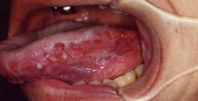 Dấu vết lạ trên lưỡi người đàn ông này hóa ra là một dạng ung thư hiếm gặp-4