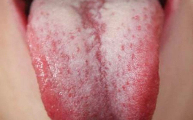 Dấu vết lạ trên lưỡi người đàn ông này hóa ra là một dạng ung thư hiếm gặp-5