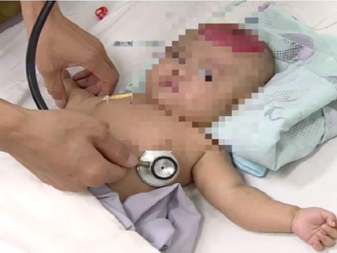 Bất cẩn để điện thoại rơi trúng đầu con, bé gái 2 tháng tuổi bị chấn thương sọ não