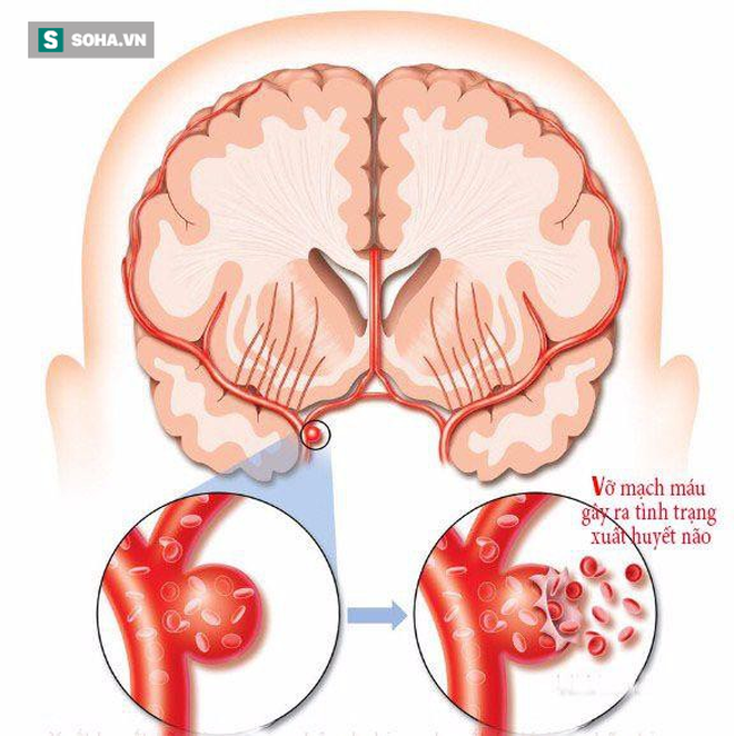 Chơi game và dùng điện thoại lâu gây chảy máu não đột ngột: Đừng để bi kịch xảy ra với bạn-1