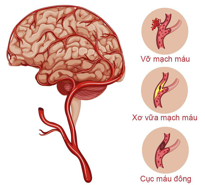 Chơi game và dùng điện thoại lâu gây chảy máu não đột ngột: Đừng để bi kịch xảy ra với bạn-3
