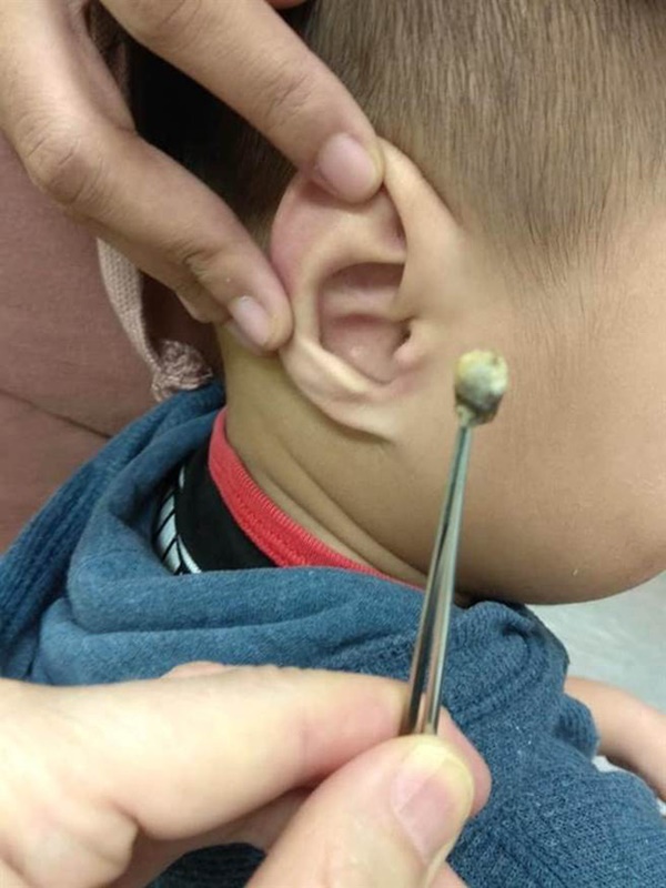 Bé trai 3 tuổi bỗng nhiên mất thính lực, đến khi bác sĩ lôi được thứ trong tai ra ai cũng rùng mình kinh sợ-2