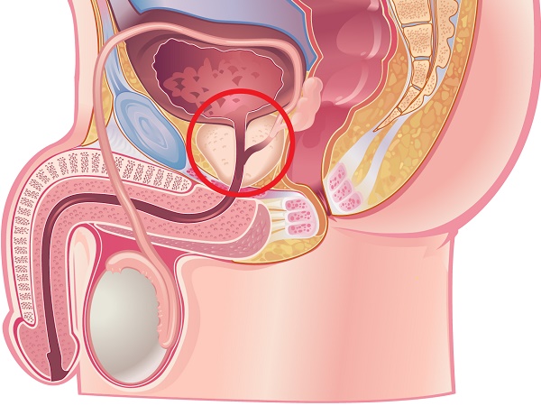 Đàn ông to cao rất dễ bị căn bệnh ung thư này tấn công: Bạn đừng để biết khi đã quá muộn-3