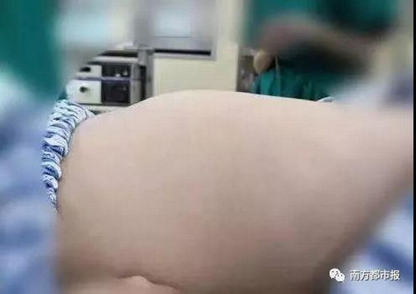 Bé gái 8 tuổi cấp cứu khẩn cấp vì tự nuốt 1,5kg tóc vào bụng-1