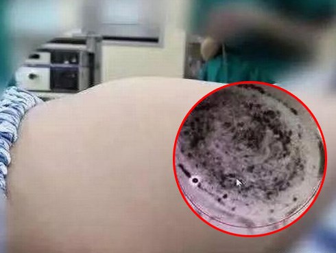 Bé gái 8 tuổi cấp cứu khẩn cấp vì tự nuốt 1,5kg tóc vào bụng