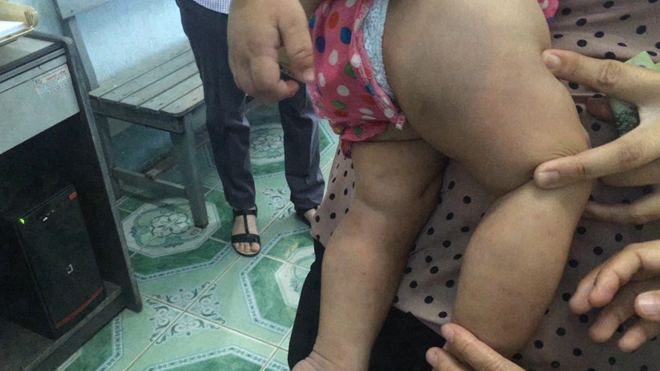 Bé gái 8 tháng tuổi nghi bị bảo mẫu đánh bầm tím-1