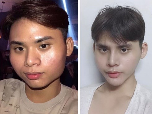 Chi 160 triệu và cả tháng trời không thể đánh răng: Câu chuyện về chàng trai trẻ PTTM vì nỗi tự ti 