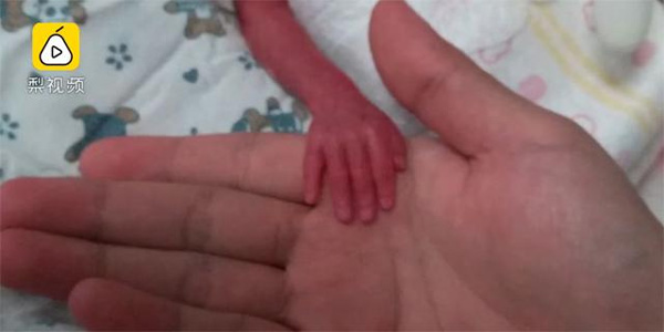 Bé sinh non ở tháng thứ 6 nặng 5 lạng, bàn tay bằng ngón tay người lớn giờ ra sao?-1