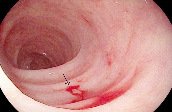 5 dấu hiệu của bệnh viêm trực tràng: Không điều trị sẽ có nguy cơ tiến triển thành ung thư-3