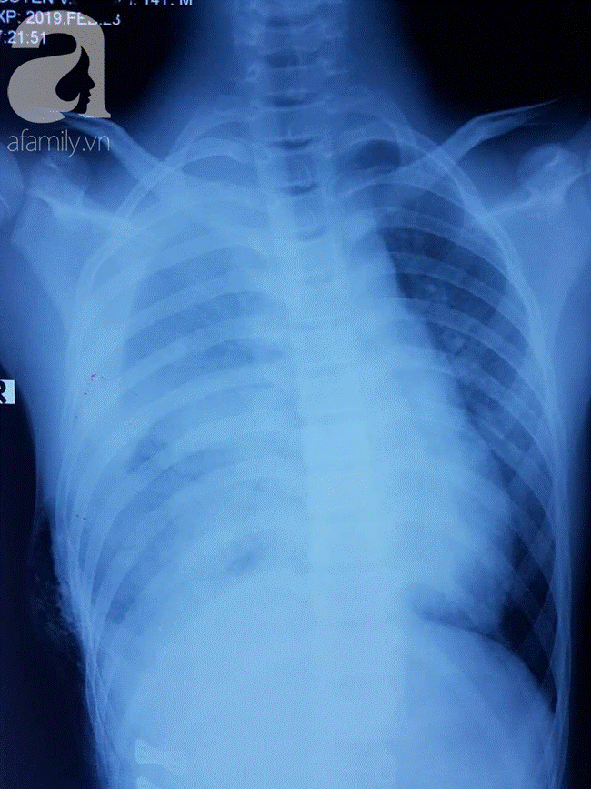 Tai nạn đau lòng: Đi làm mướn nuôi cha tâm thần, bé trai 13 tuổi bị thanh sắt máy cắt lúa đâm xuyên thấu ngực-3