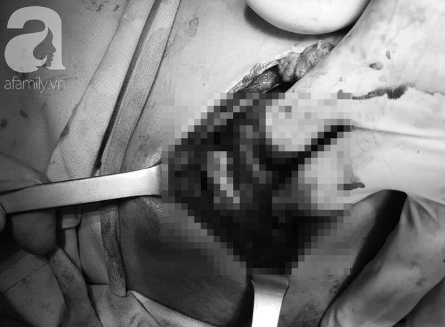 Tai nạn đau lòng: Đi làm mướn nuôi cha tâm thần, bé trai 13 tuổi bị thanh sắt máy cắt lúa đâm xuyên thấu ngực-5