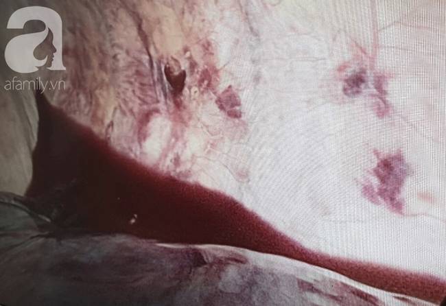 Tai nạn đau lòng: Đi làm mướn nuôi cha tâm thần, bé trai 13 tuổi bị thanh sắt máy cắt lúa đâm xuyên thấu ngực-2