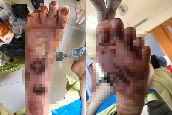 Chàng trai 28 tuổi bị mục ruỗng bàn chân dù chỉ từ vết xước nhỏ-1