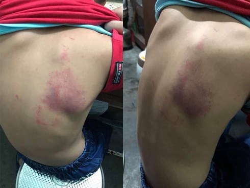 Hải Phòng: Cô giáo đánh học sinh tím lưng vì làm bài kém