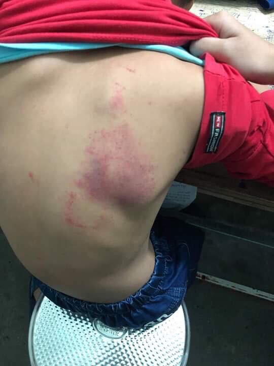 Hải Phòng: Cô giáo đánh học sinh tím lưng vì làm bài kém-1