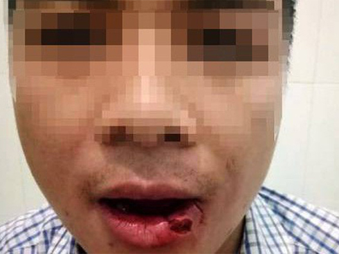 Thầy giáo ném thanh sắt làm cán bộ tòa án gãy 5 chiếc răng: Tôi buồn và rất hối hận-3