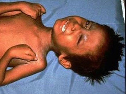 Trung tâm kiểm soát và phòng ngừa dịch bệnh Mỹ lên tiếng: Một cậu bé 6 tuổi suýt chết vì uốn ván do bố mẹ anti-vaccine