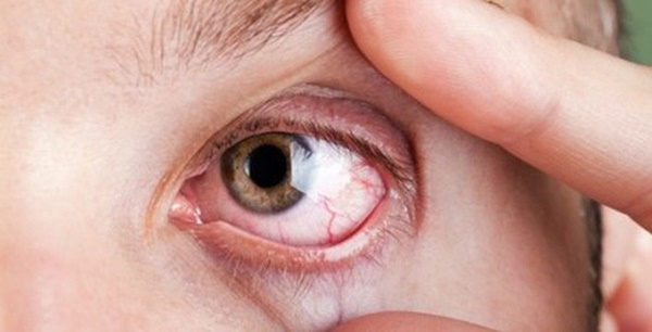 Phân biệt đau mắt đỏ và dị ứng thường gặp vào mùa xuân-2