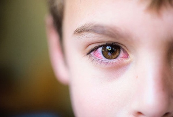 Phân biệt đau mắt đỏ và dị ứng thường gặp vào mùa xuân-3
