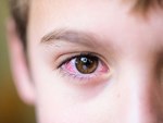 Đau mắt đỏ: Bệnh dễ gặp khi thời tiết sắp chuyển sang nóng bức-5