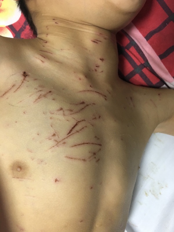 Bé trai 9 tuổi, bại não bị chó nhà cắn thương tâm: Trầy xước khắp người, nát bộ phận sinh dục-1