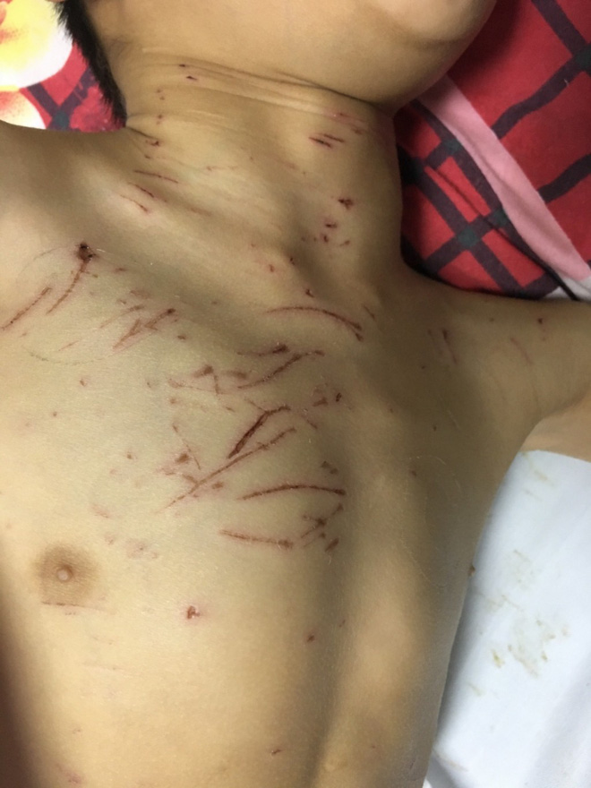 Bé trai 9 tuổi bại não bị 4 con chó của nhà trèo lên giường cắn đứt vùng kín-2