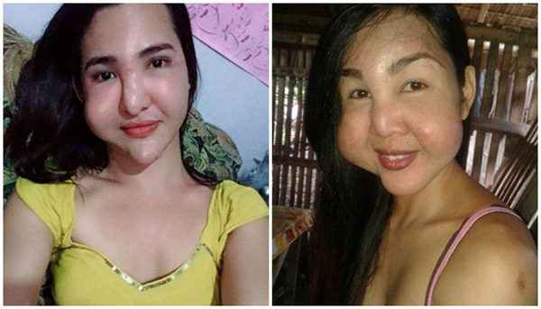 Đôi bạn thân cùng tiến: Rủ nhau phẫu thuật thẩm mỹ chui, đến lúc biến dạng cả khuôn mặt cũng có nhau-3