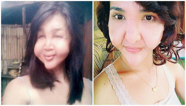 Đôi bạn thân cùng tiến: Rủ nhau phẫu thuật thẩm mỹ chui, đến lúc biến dạng cả khuôn mặt cũng có nhau-4