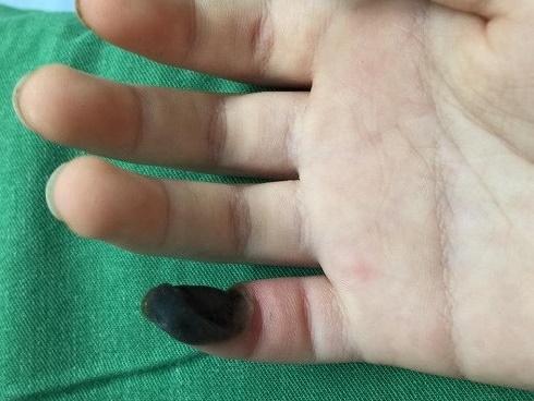 Dùng muối đá Himalaya bị hoại tử chân và những nguy hiểm khủng khiếp-3