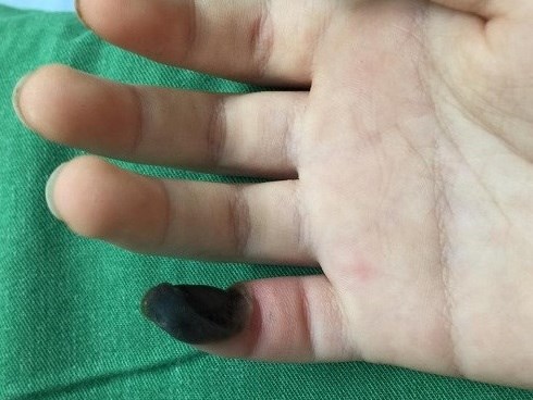 Bé gái hoại tử ngón tay vì tự chữa mụn cóc bằng thuốc mua trên mạng