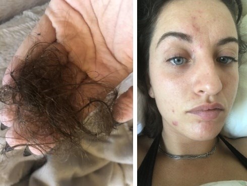 Có thứ này trong nhà nhiều năm, cô gái 29 tuổi bị kiệt sức, mất trí nhớ, rụng tóc và