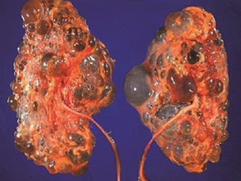 Cậu bé 10 tuổi bị suy thận, bác sĩ cảnh báo 3 loại thực phẩm cực hại-4