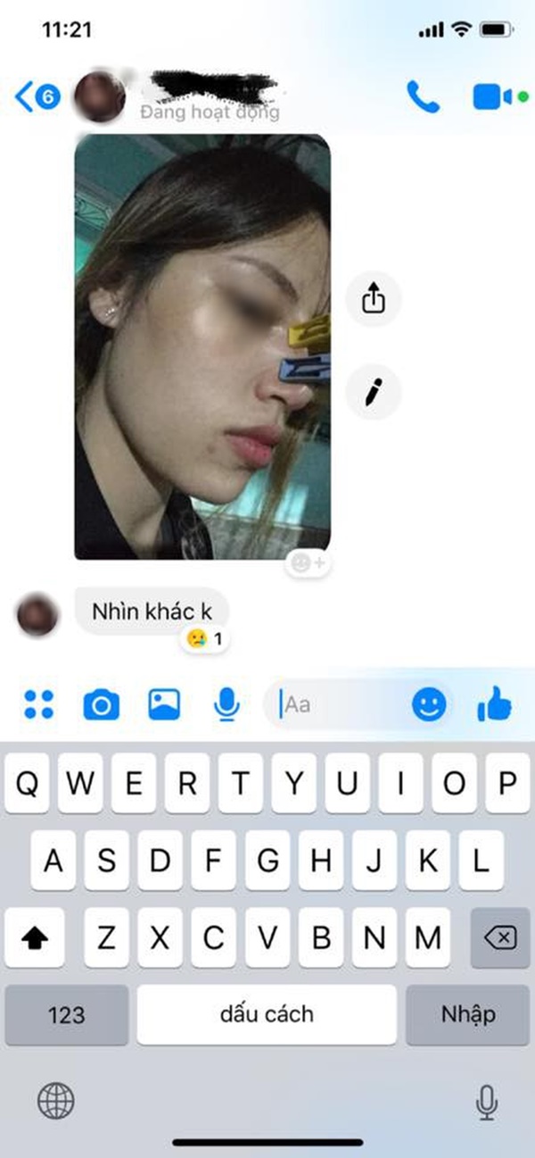 Tin lời chị em cây khế, cô gái trẻ dùng kẹp quần áo để nâng mũi tự thân không cần phẫu thuật-1