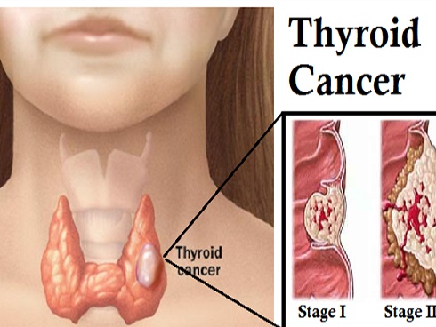 Em bé 2 tuổi bị bệnh ung thư khiến cả nhà sửng sốt bởi vì đây là bệnh ung thư nguy hiểm thường mắc ở phụ nữ trưởng thành-4