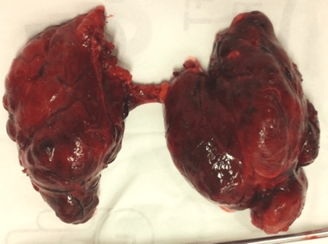 Hai chị em sinh đôi cùng mắc 1 bệnh ung thư: Bác sĩ chỉ ra dấu hiệu cần nhớ-1