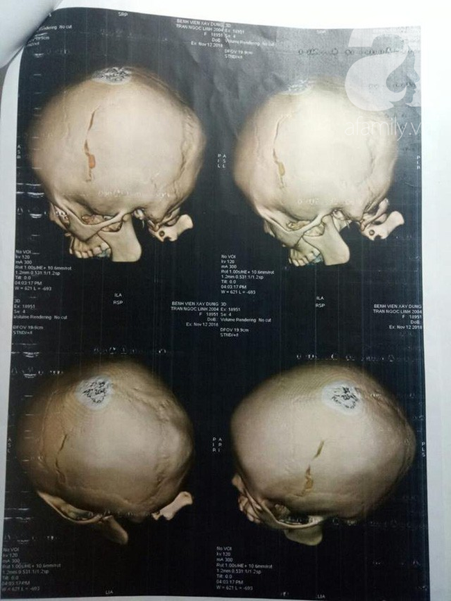 Nữ sinh lớp 9 tố bị vợ 2 của bố đánh chấn thương phải lưu ban do nghỉ quá số ngày quy định-4