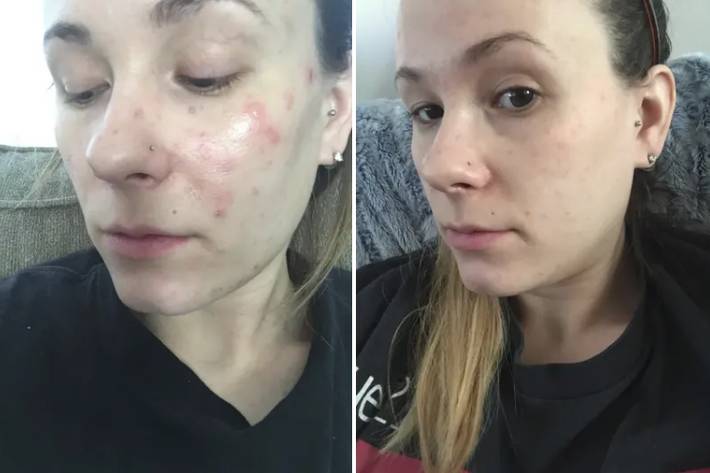 5 sản phẩm đơn giản nhưng lại trị mụn, làm đẹp da cực tốt với minh chứng là loạt ảnh trước/sau đầy ấn tượng-10