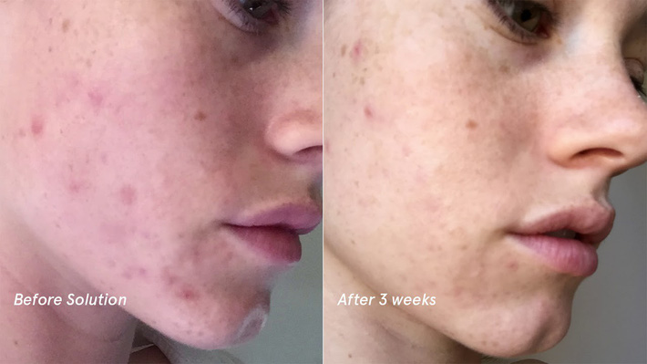 5 sản phẩm đơn giản nhưng lại trị mụn, làm đẹp da cực tốt với minh chứng là loạt ảnh trước/sau đầy ấn tượng-2