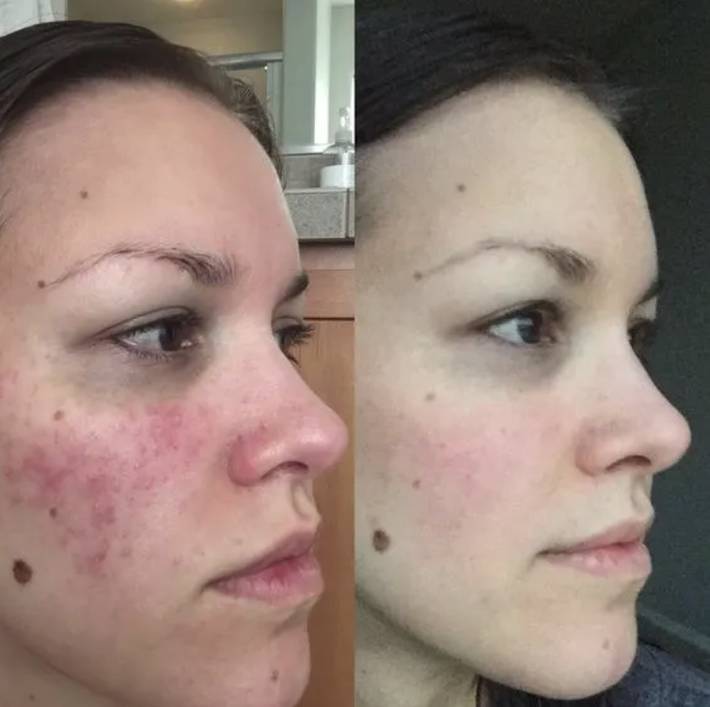 5 sản phẩm đơn giản nhưng lại trị mụn, làm đẹp da cực tốt với minh chứng là loạt ảnh trước/sau đầy ấn tượng-4