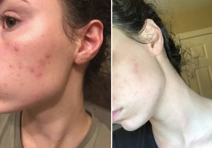 5 sản phẩm đơn giản nhưng lại trị mụn, làm đẹp da cực tốt với minh chứng là loạt ảnh trước/sau đầy ấn tượng-6