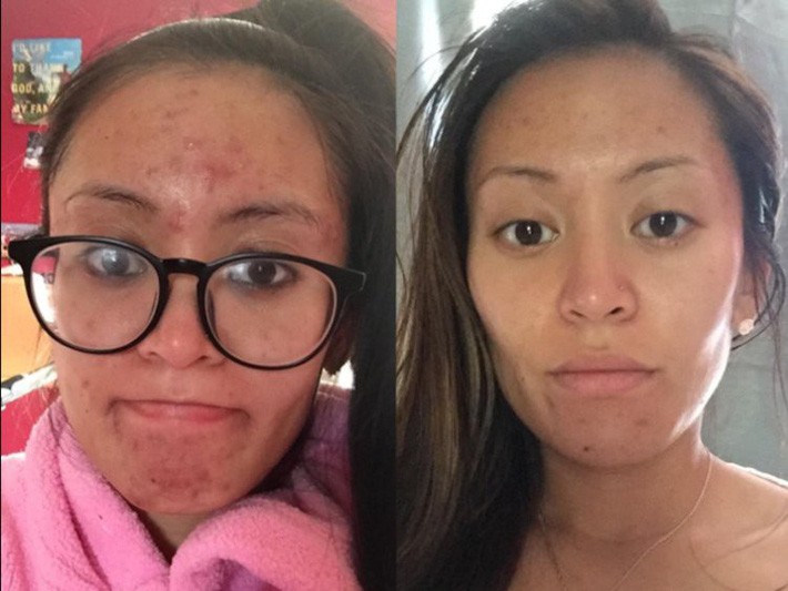 5 sản phẩm đơn giản nhưng lại trị mụn, làm đẹp da cực tốt với minh chứng là loạt ảnh trước/sau đầy ấn tượng-8