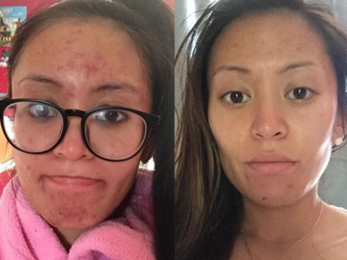 Được các bác sĩ da liễu ủng hộ hẳn hoi, đây là 5 công thức trị mụn bọc cây nhà lá vườn rẻ bèo nhưng lại cực hiệu quả-6