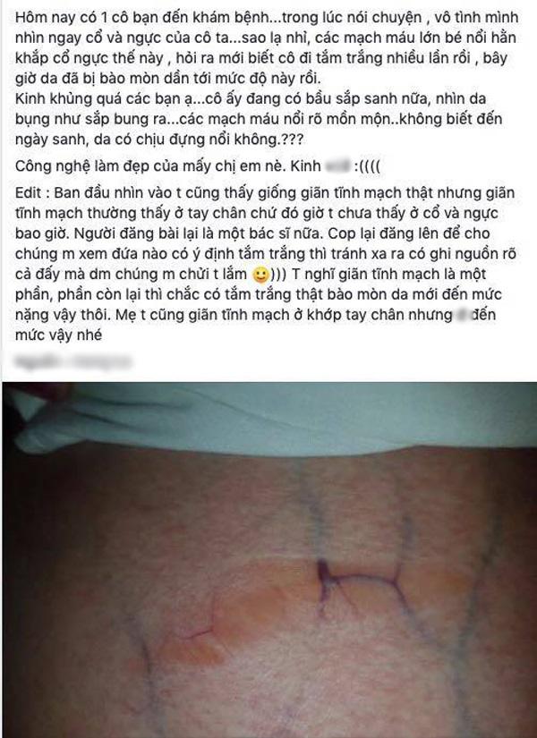 Người nổi đầy gân xanh như trong phim kinh dị, tất cả là bởi phương pháp làm đẹp này-2