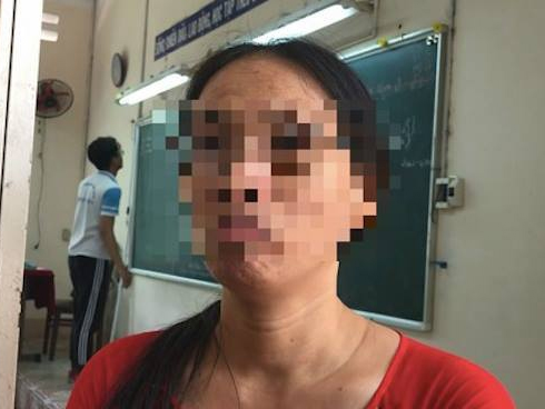Không chịu giữ trẻ cắn bạn, giáo viên mầm non bị phụ huynh đánh nhập viện-2